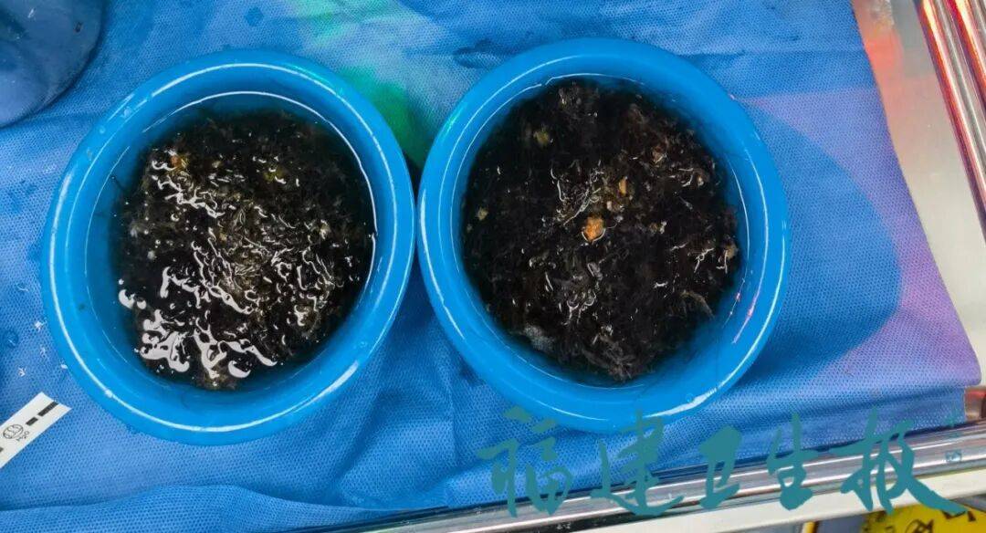 皇冠信用网账号申请_发现一例皇冠信用网账号申请,10岁女孩确诊!已有多起病例,有人因羞耻感延误就医